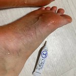 20대 초반에 <b>무좀</b> 걸려본사람?