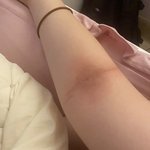 나 팔에 <b>습진</b> 생겼는데 샤워 어떻게함?