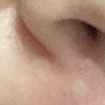 아 <b>코밑</b>에 여드름 올라온다