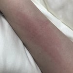얘들아 내 <b>팔</b> 왜이러지 뭐 알레르기 일어난건가