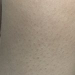 나 모공각화증 <b>개심</b>함;;