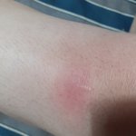 [조언과댓글] <b>자고</b> 일어났는데 빨갛게. 부음