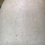 [댓글부탁해] <b>닭살</b>피부 ㄹㅇ 스트레스