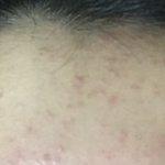 내 피부 여드름 <b>종류</b>뭐여...? 혐주의