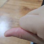 [댓글부탁해] 이거 화상 <b>물집</b>이야??