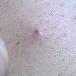 인그로운 헤어 땜에 <b>화병</b> 생기기 일보 직전 ..
