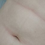 [꼭조언부탁] <b>배</b>에 빨간 줄 어케 없앰