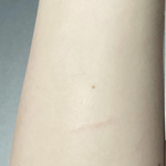 [댓글부탁해] 너네 <b>콜린</b>성 두드러기 아냐