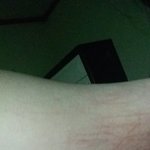 ㅈㄴ 극혐 징그러움 주의 일어나보니까 팔 <b>자해</b>한거처럼됨;