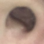 <b>코안</b>에 뾰루지 어떡해