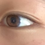 내 눈 밑에 지방임 다크<b>서클</b>임??