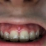 교정기 뺀 사람의 <b>발악</b>