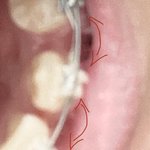 [드루와] 교정 <b>발치</b> 진짜 개신기하다....