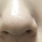 [댓글부탁해] 얘들아 내 코 <b>복코끼</b> 없애려면 뭔 수술해야됨