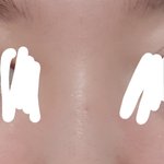 나 코수술할까