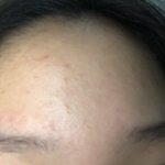 [댓글부탁해] 내 <b>피부</b> <b>정도</b>면 피부과 가야할까??