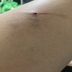 [꼭조언부탁] 개한테 물렸습니다
