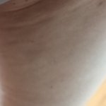 [꼭조언부탁] 신사역 성형외과 부작용