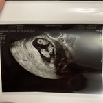 [꼭봐주세요] (청원동의)(의료사고)미숙아 퇴원 이틀 만에 사망...