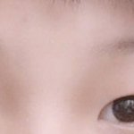 쌍수 앞트임 1년<b>반차</b> 전후 비교