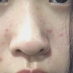 너네도 요즘 여드름 <b>개</b>많이 남?