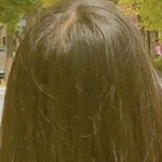 나 탈모니?