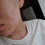 혐)여드름 흉터 없애는 법 아는 사람ㅜㅜㅠ 제발