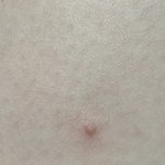 [댓글부탁해] (약혐)<b>허벅</b>ㅈ에 여드름 나는 건 무슨 경우지