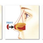 [댓글부탁해] 이 <b>코수술</b> 위험해보임?