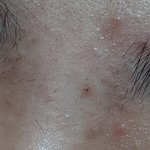 [댓글부탁해] 사진주의) 이런여드름은 뭐라고 해?ㅠㅜ 해결방법도 <b>plz</b>