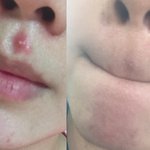 화농성여드름 이걸로 조져!!!!
