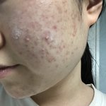 얘들아 나 피부 진짜많이 좋아졌지(혐)
