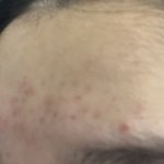 [댓글부탁해] 얘드라ㅠㅠㅠ이마에 이런거 뭐야ㅠㅠ??