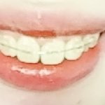 [드루와] 나 교정 <b>전후</b> 차이 개 쩔엌ㅋㅋㅋㅋ