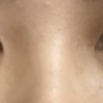 [19] 코수술 할까 ㅜㅜ