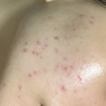 지성 <b>피부</b> 여드름 땜시 썩음 ㅋ