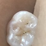 나 중3인데 이빠졌어