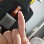 손가락 이거 <b>습진</b>임?