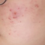 [19] !!<b>사진</b>주의!! 이런 울긋불긋한 여드름은 <b>무슨</b> 연고 발라야...