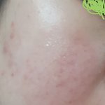 [꼭조언부탁] 피부과 갔는데