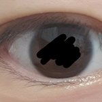 쌍수 <b>재수술</b>할까