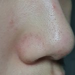 블랙<b>헤드</b> 없애는방법좀 ㅠㅠ
