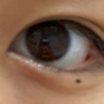 나 눈<b>밑점</b>