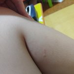 [댓글부탁해] 개미한테 물렸어