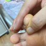 [19] 이거 <b>내성</b>발톱임?