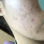 [이것좀봐줘] 블랙헤드 뽑다가 <b>좁쌀</b>까지 잠재움 ㅠㅠㅠㅠ