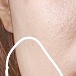 [댓글부탁해] 나 <b>사각</b>턱 보톡스 효과 있을까