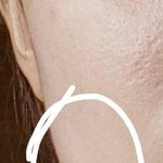 [댓글부탁해] <b>사각</b>턱 보톡스 여기 근육인데 효과있을거같냐