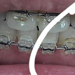 [꼭조언부탁] 교정중인데 <b>잇몸</b> 상태가 이상한거같아요
