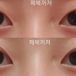 [댓글부탁해] @@쌍수 할지말지 말해주면 내가 매우 기쁨@@